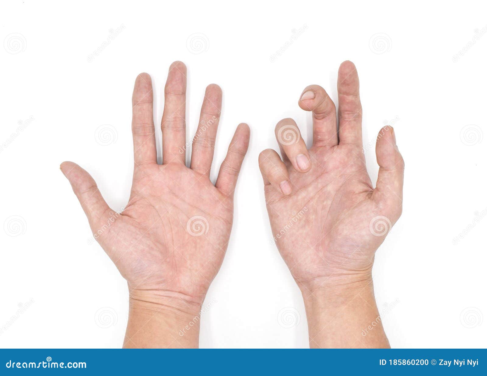 dupuytrenÃ¢â¬â¢s contracture in right hand compared to left normal one in asian young man. it is a fibrosing disorder.
